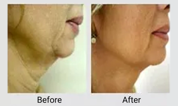 Med Spa Dickinson TX Before And After Neck