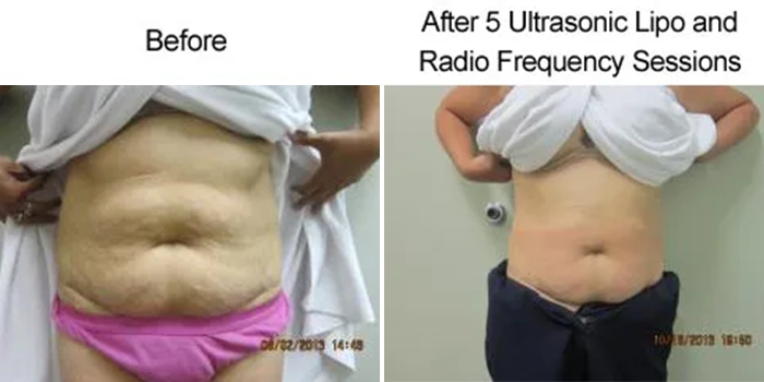 Med Spa Dickinson TX Ultrasonic Lipo And Radio Frequency Before And After